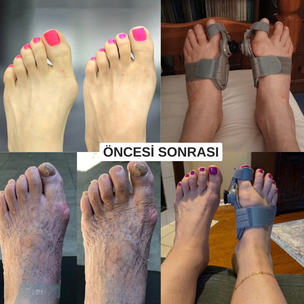 OrthoCare MedikalEvin™ Başparmak Düzeltici